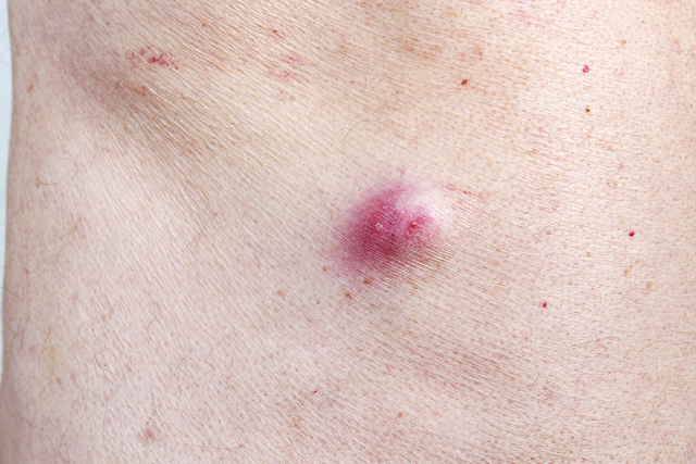 How to Identify and Treat Common Skin Cysts