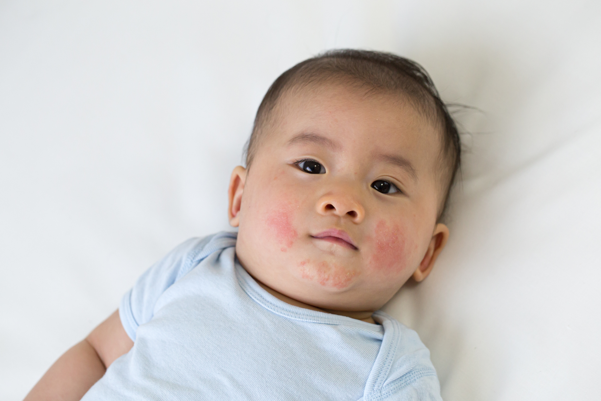  Skin Conditions in Children