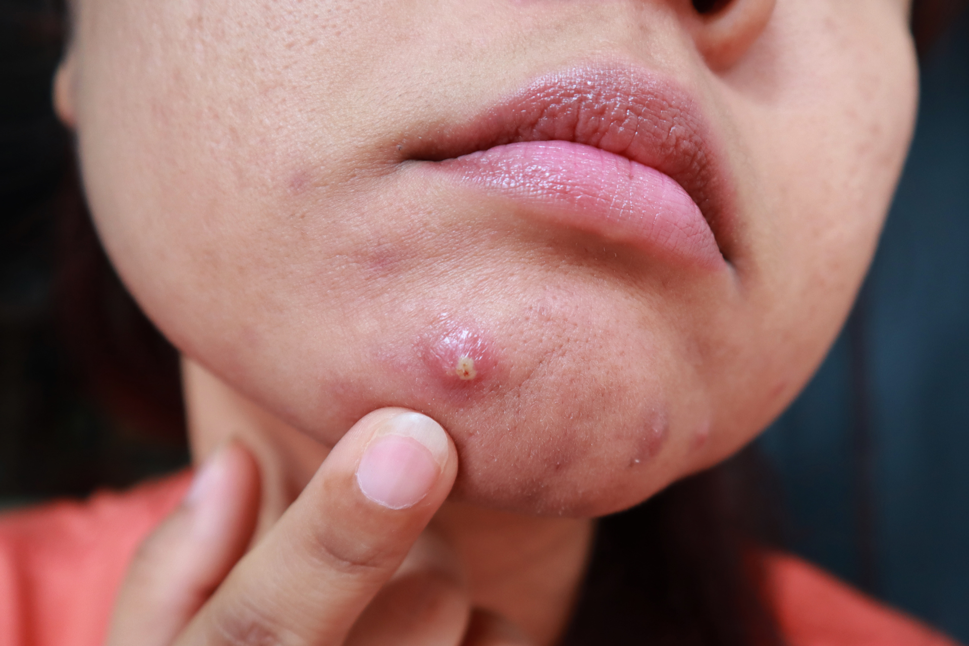 Cystic Acne