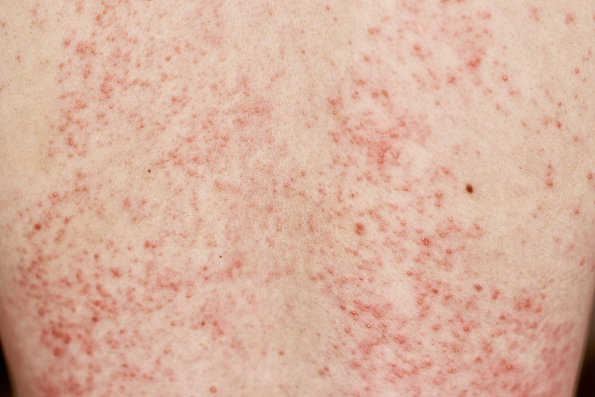  Skin Rashes