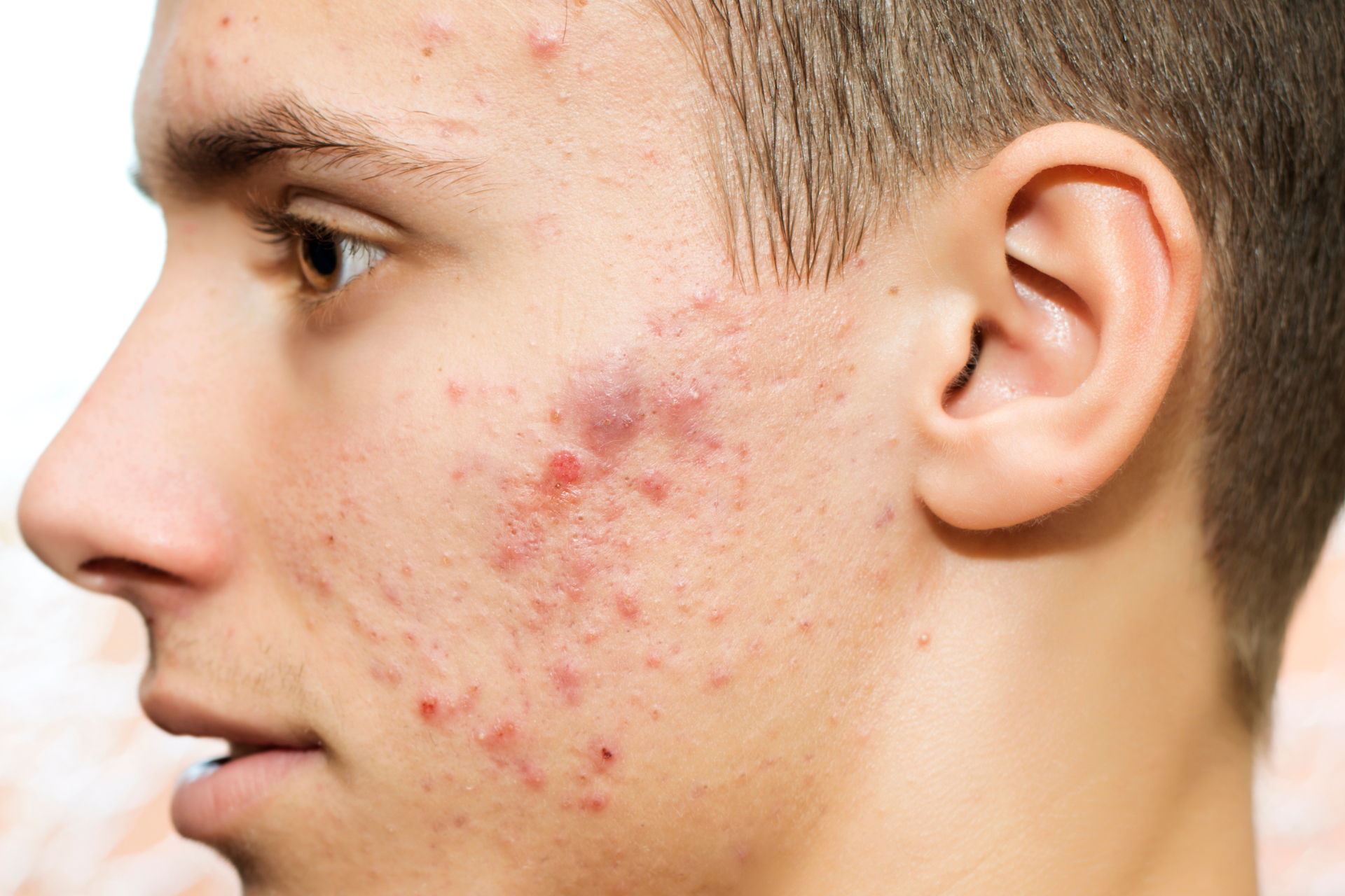 Managing and Treating Acne