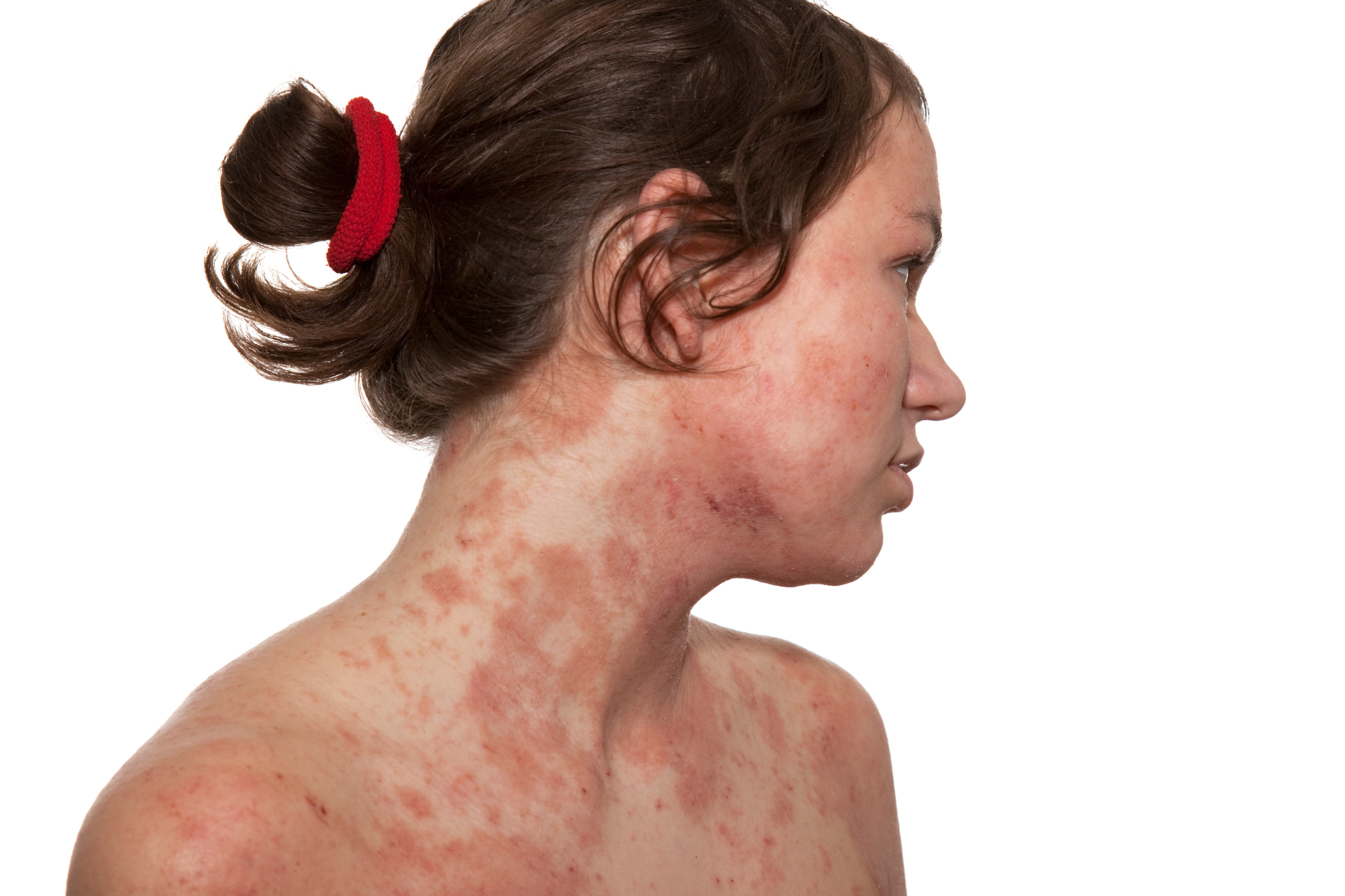 Managing Eczema