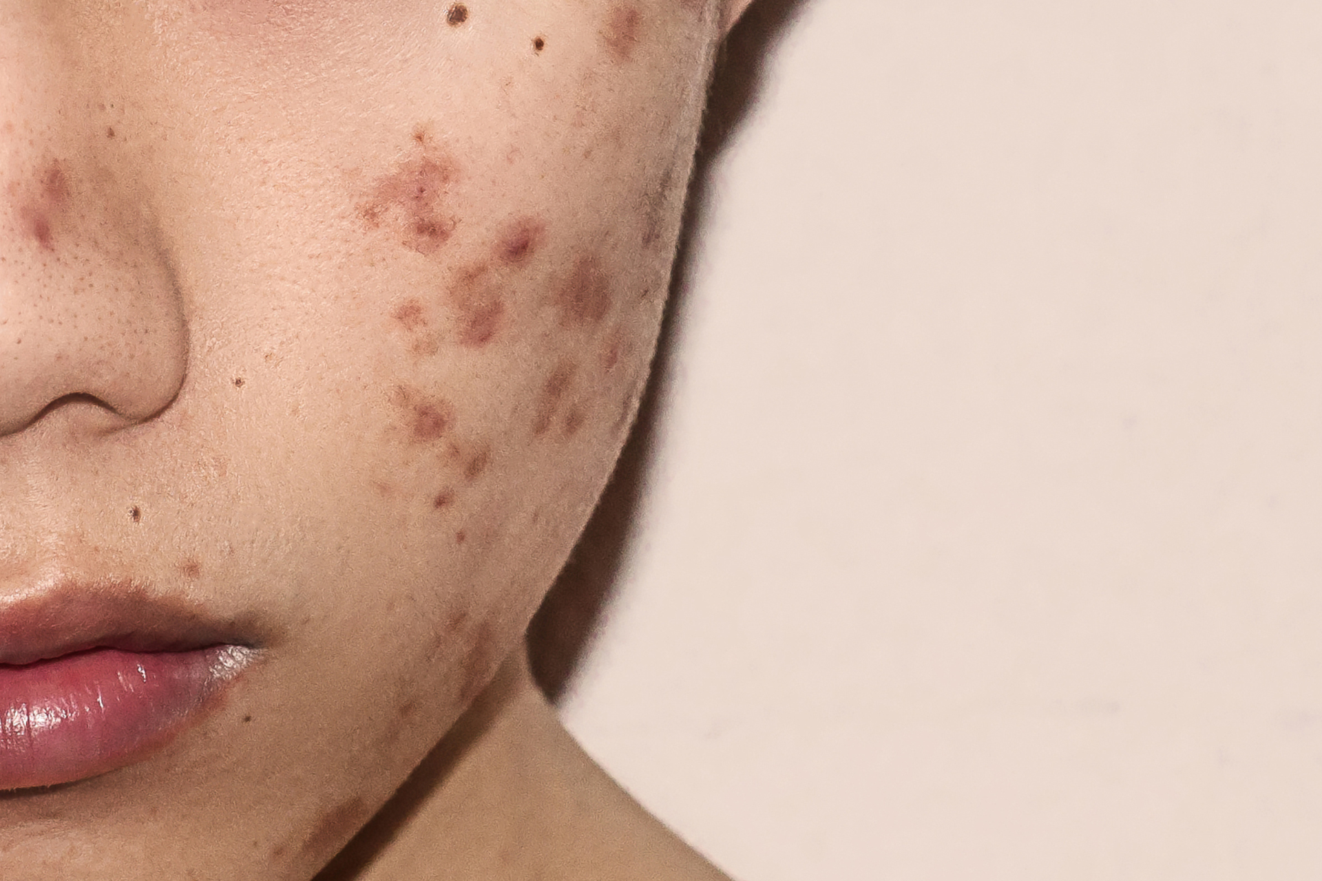 Acne Scars