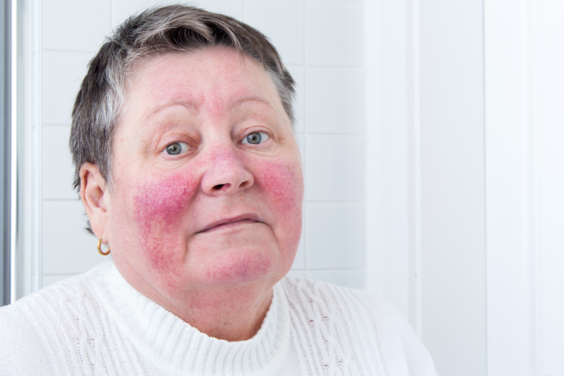 Rosacea