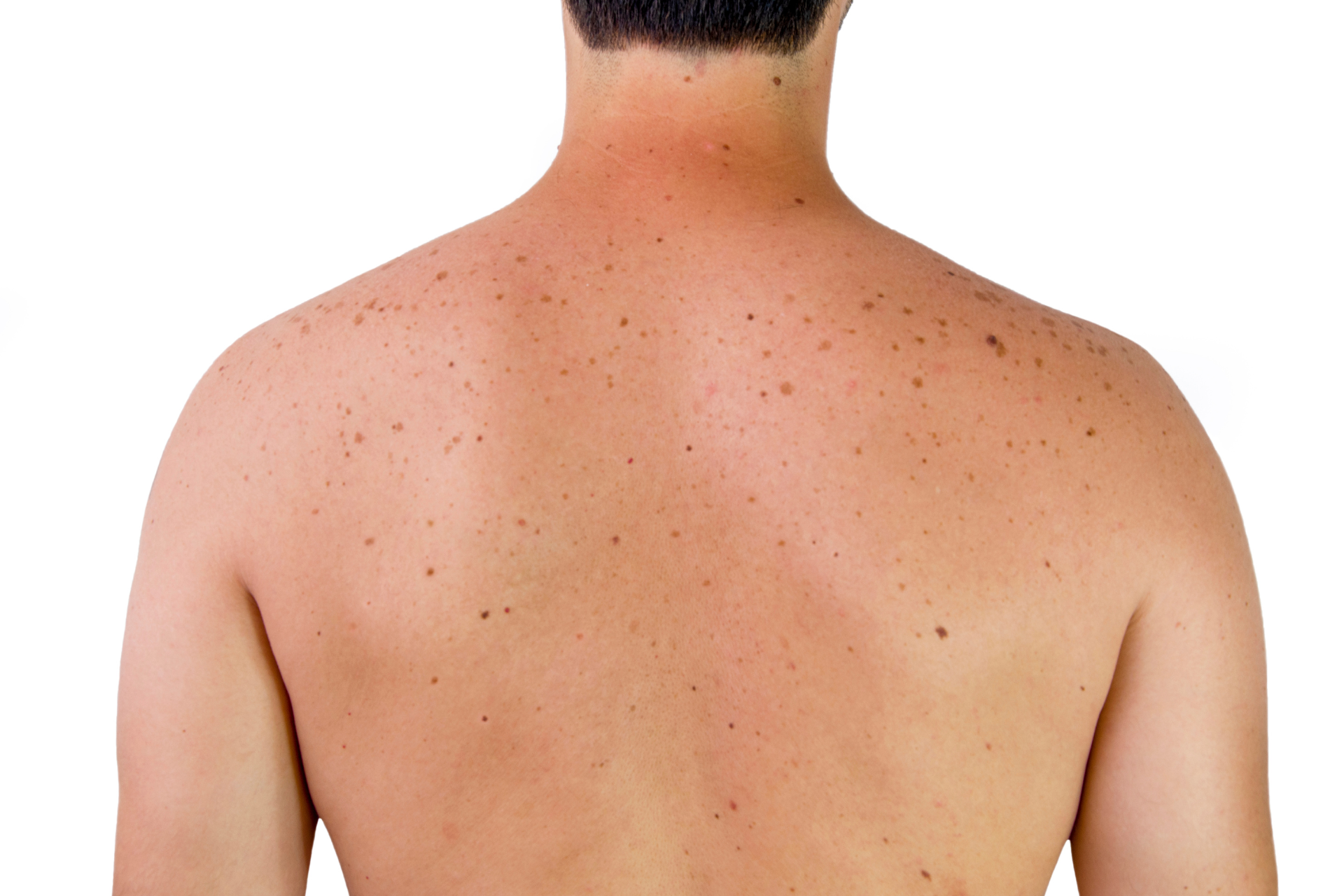 Age Spots on the Shoulder