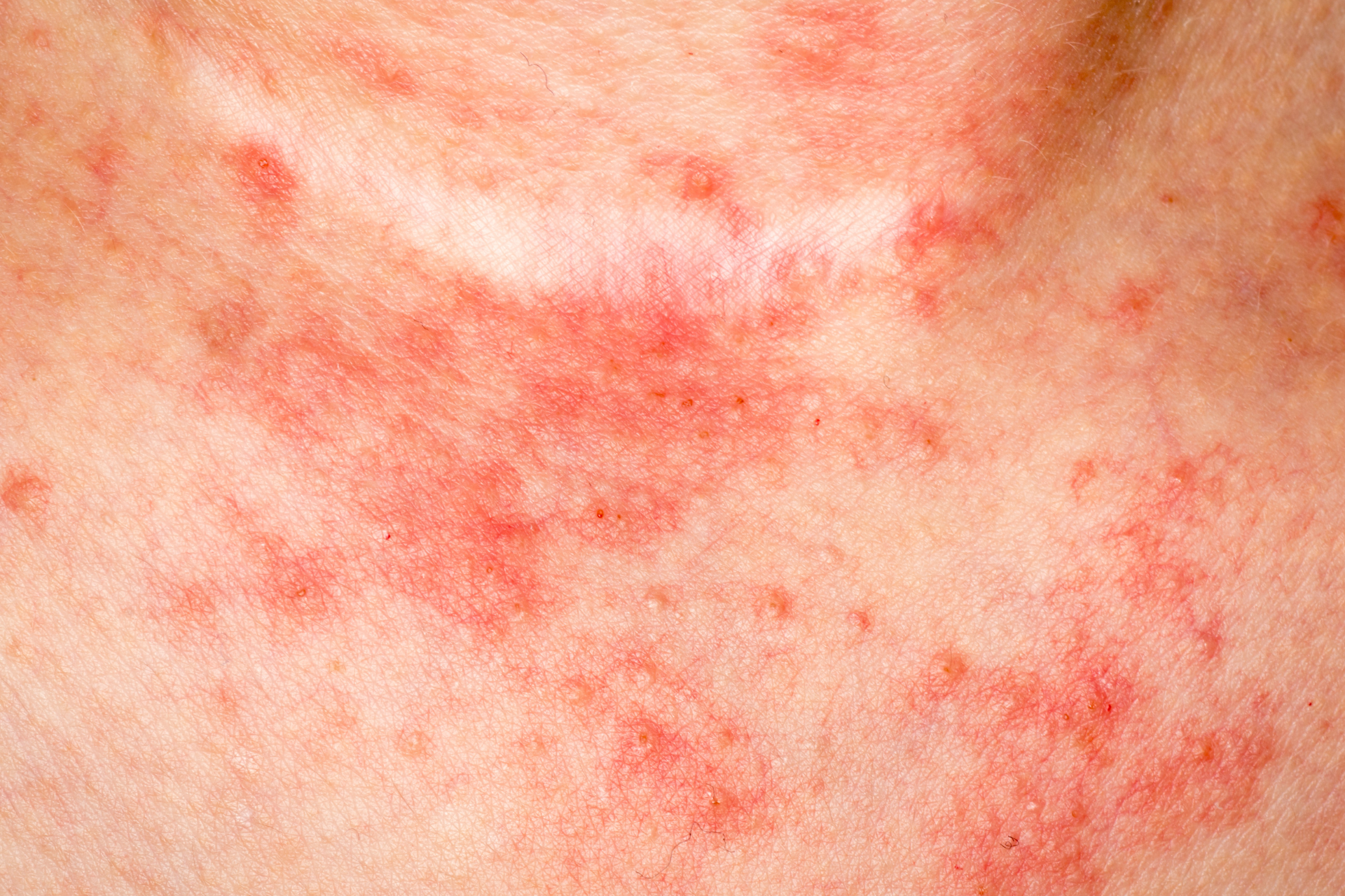 Eczema