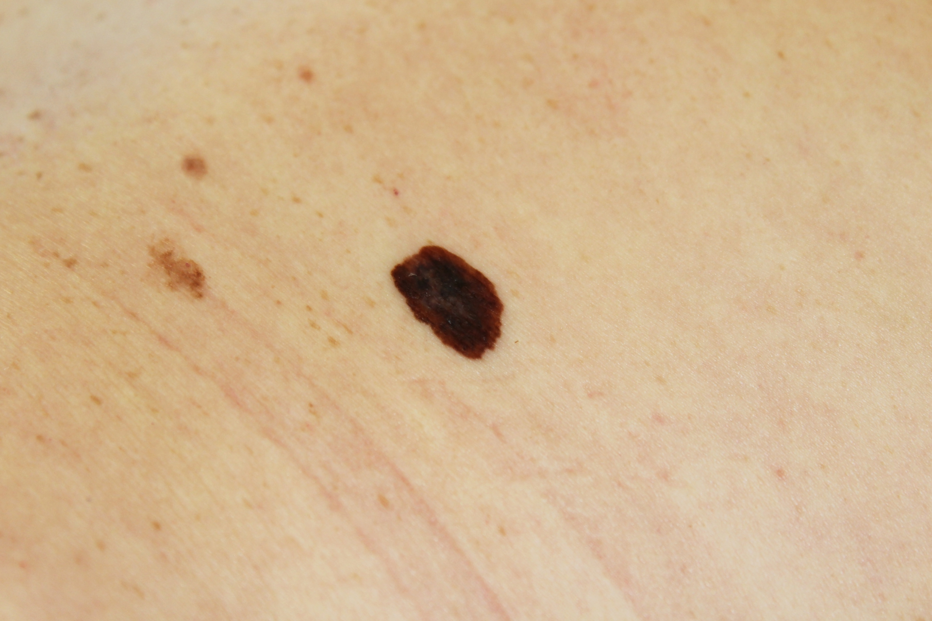 Melanoma-Skin Cancer