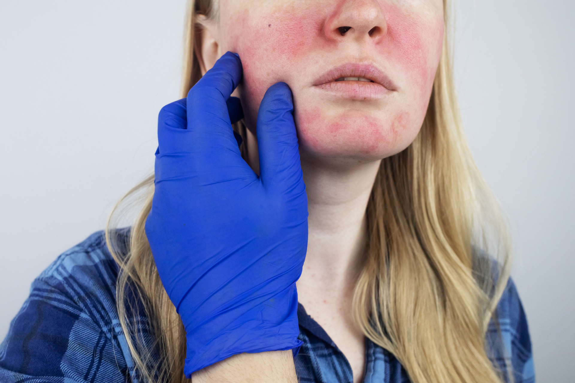 Rosacea