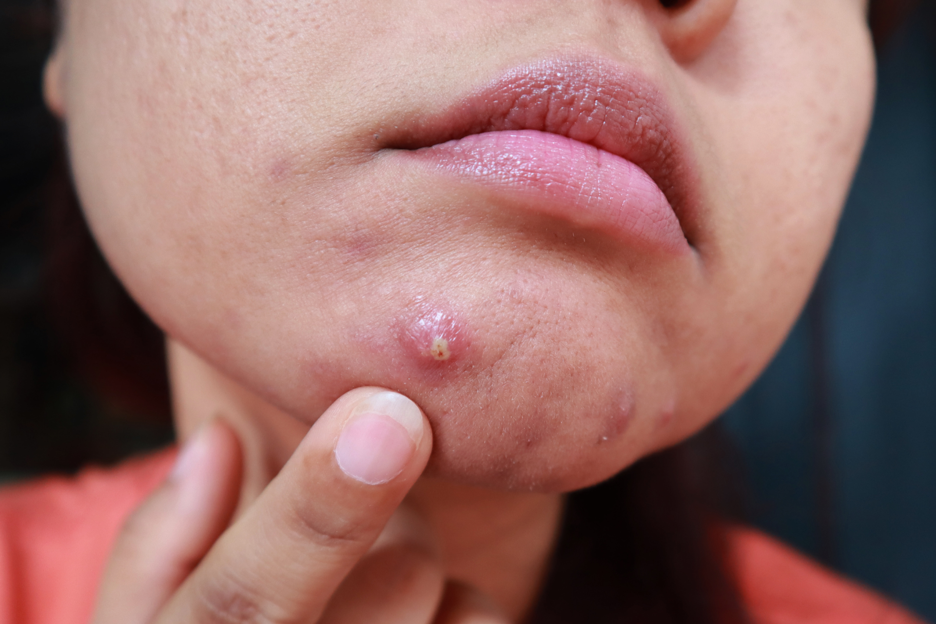 Cystic Acne 