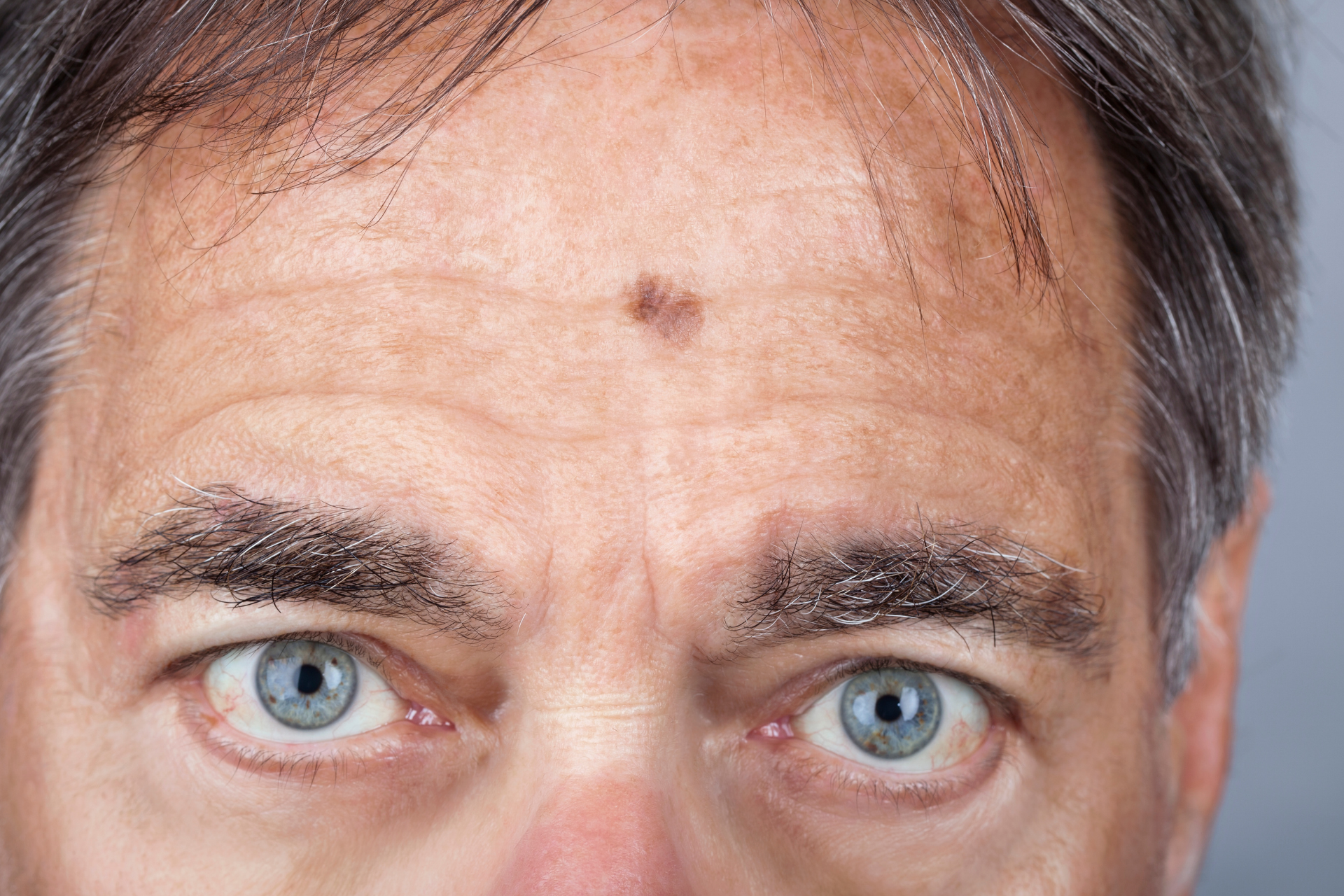 Melanoma on a Man's Forehead