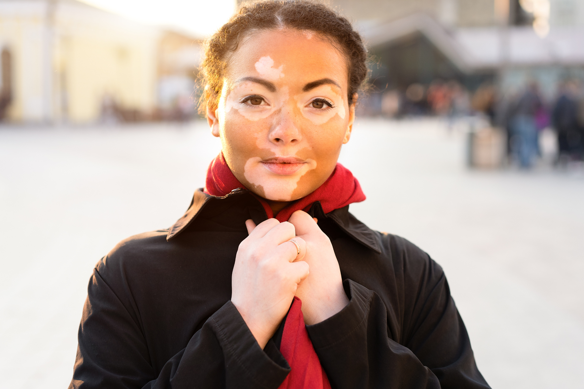 Young Girl with Vitiligo