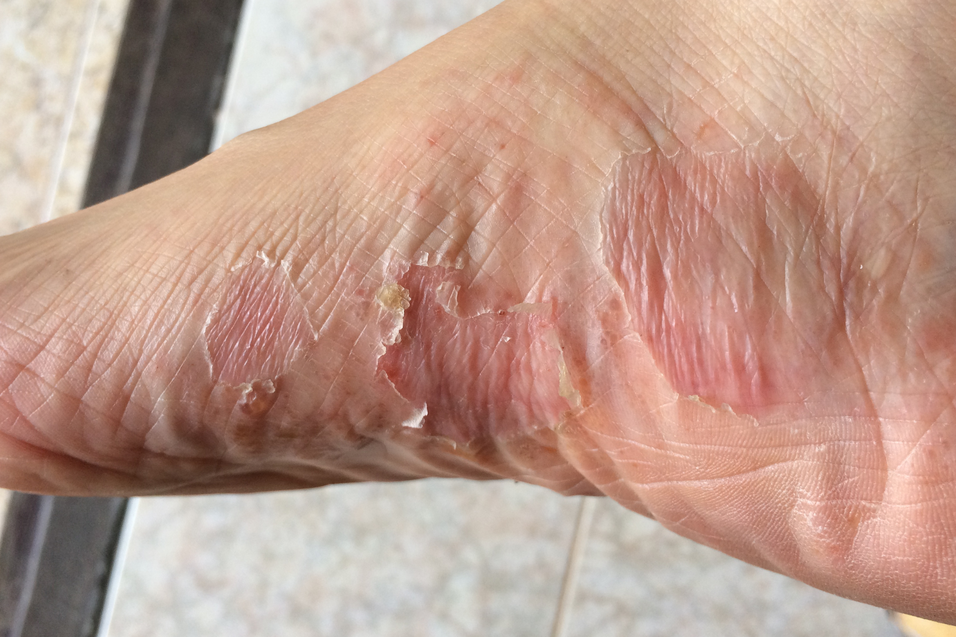  Skin Infection