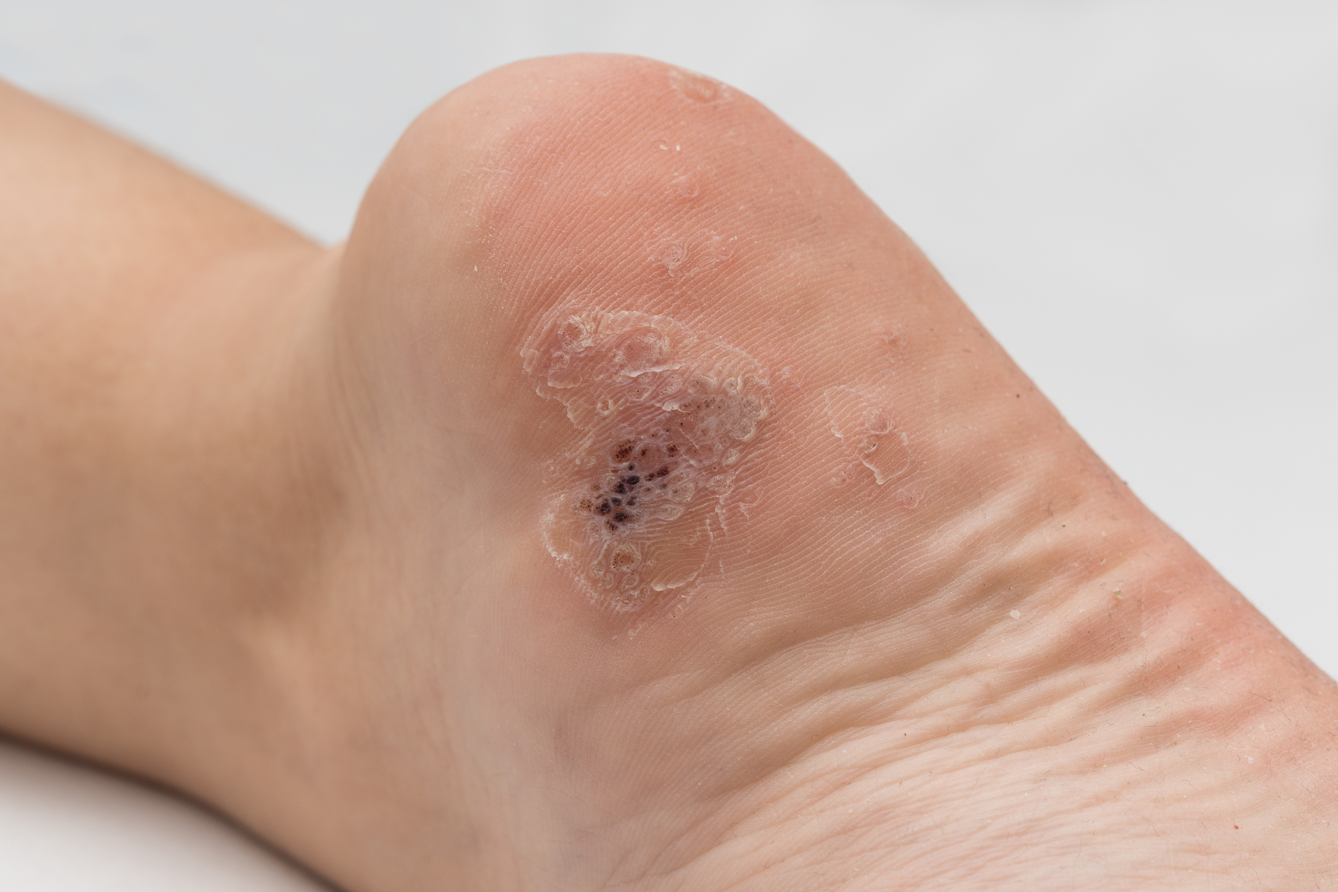 Wart on Foot