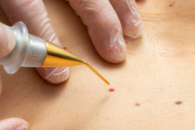 Wart Removal: Safe and Effective Treatments