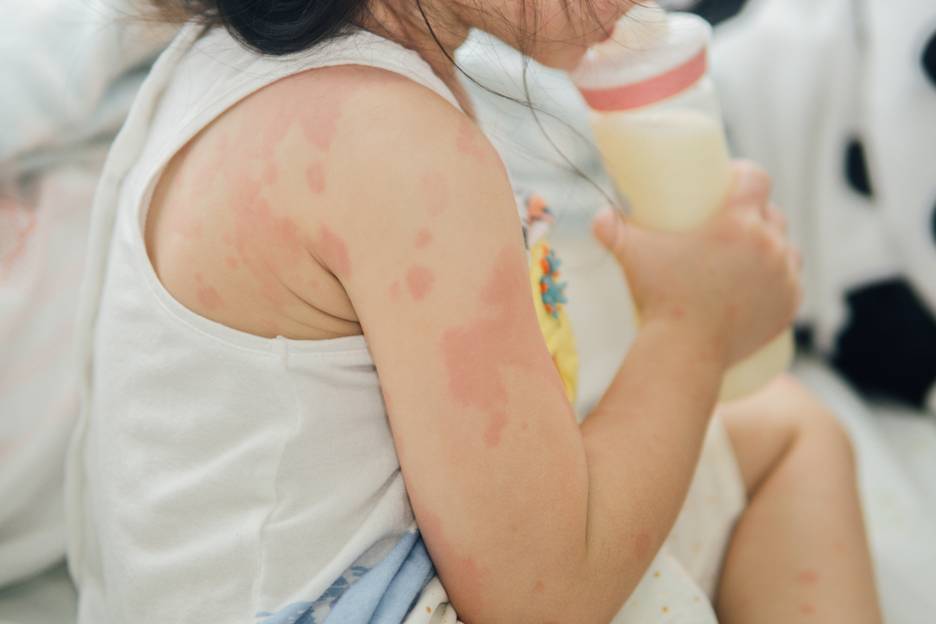 Skin Reaction to Allergy 