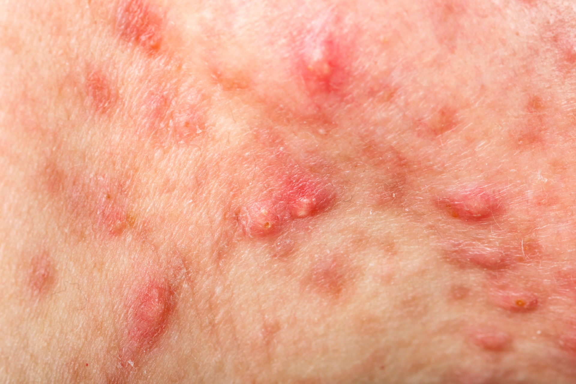 Cystic Acne