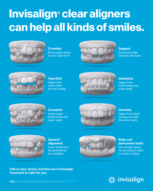 Invisalign Clear Aligners | Types Of Misalignment In Teeth | Crowded Teeth | Gapped Teeth | Openbite | Underbite | Crossbite | Overbite | General Alignment | Baby and Permanent Teeth