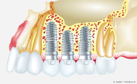 Implantate zum Ersatz fehlender Zähne Implantate zum Ersatz fehlender Zähne