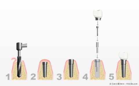 Die meisten Implantate werden im sog. zweiphasigen Verfahren eingesetzt. Die meisten Implantate werden im sog. zweiphasigen Verfahren eingesetzt.