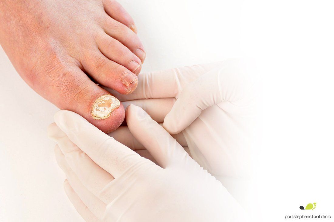 Fungal Nails Newcastle Podiatry