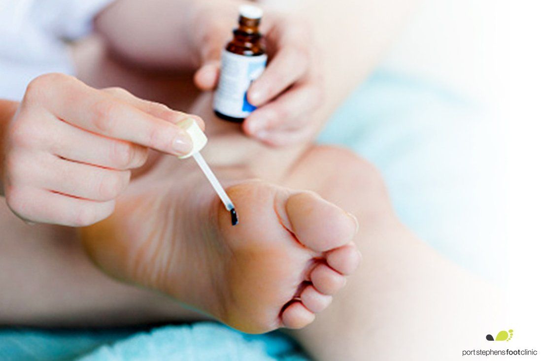Plantar Warts Newcastle Podiatry