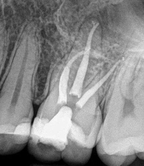 A black and white x-ray of a tooth with a hole in it — Barry Bennett Dental In Earlville, QLD