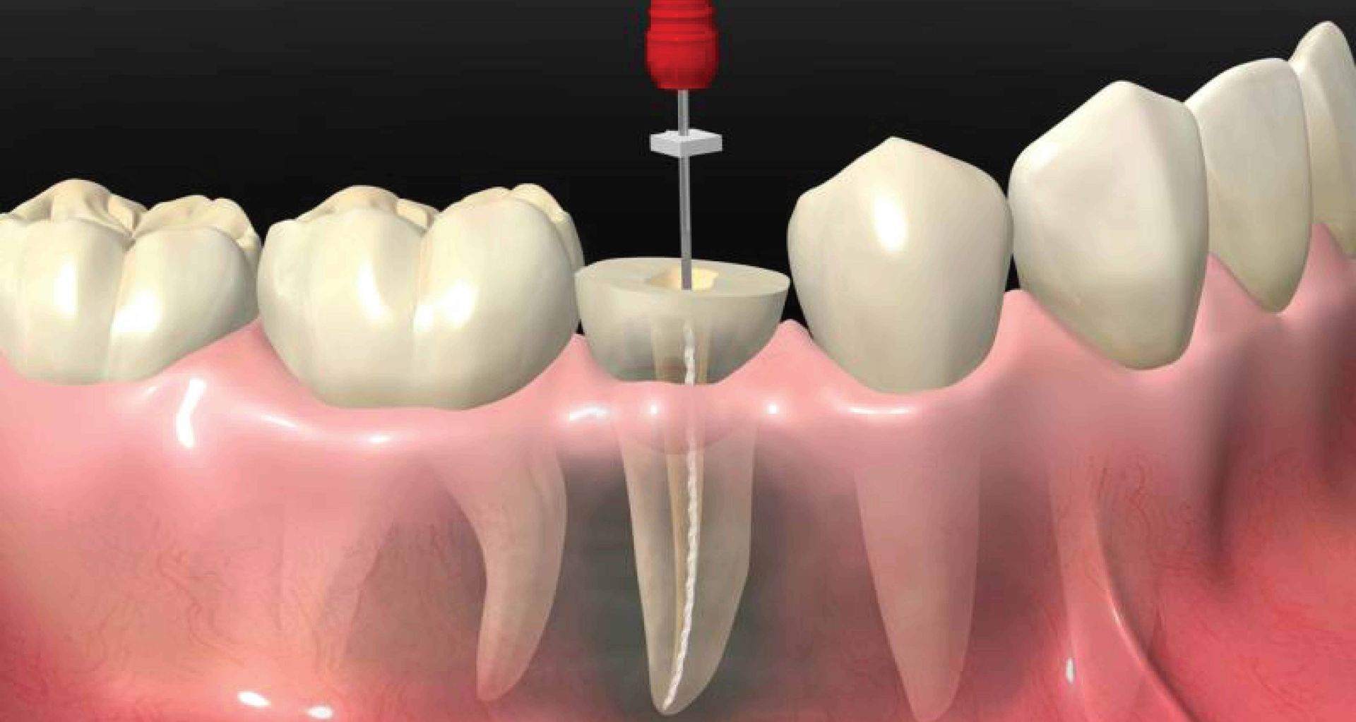 A computer generated image of a tooth being drilled with a red needle — Barry Bennett Dental In Earlville, QLD