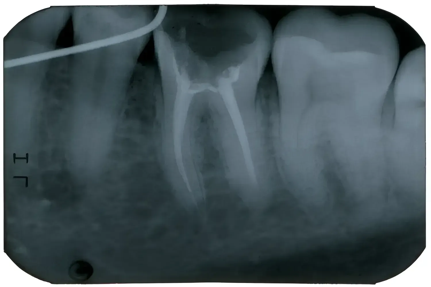 An X-ray Of A Tooth With A Hole In It — BB Dental Cairns Dentists Dental In Earlville, QLD