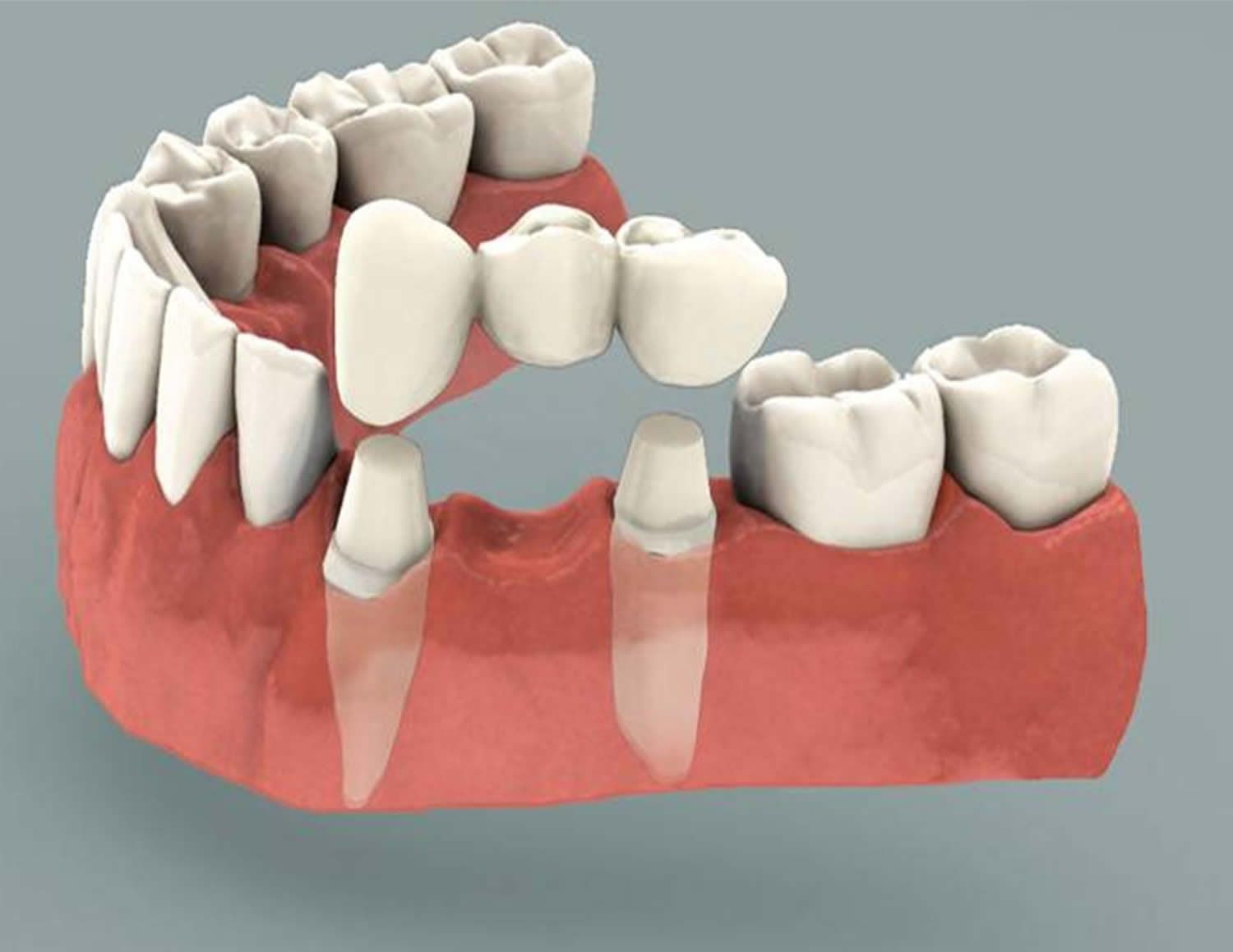 Dental bridge model showing teeth and gums, highlighting the bridge's components.