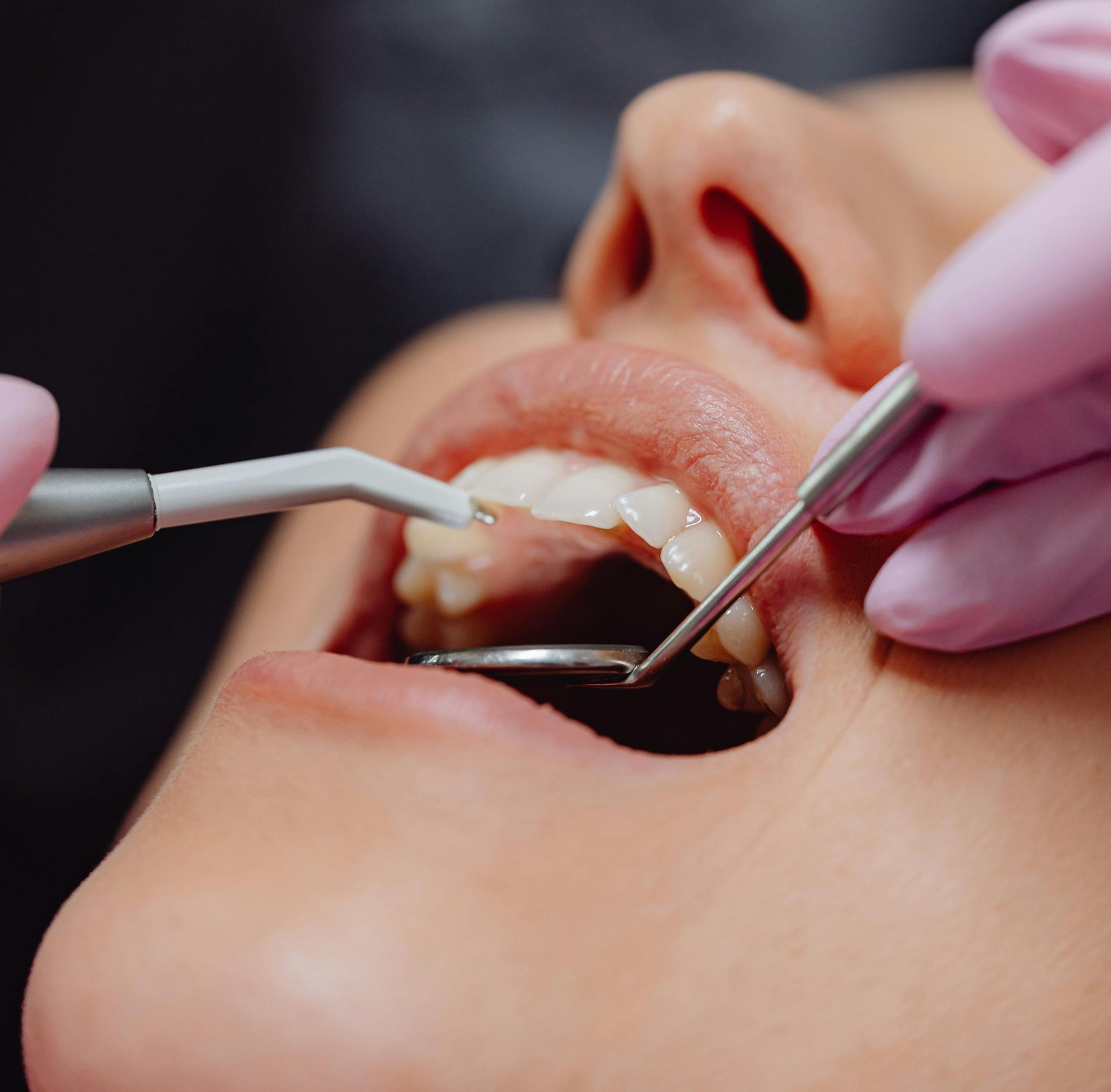 A Person Receiving A Teeth Clean Service— BB Dental Cairns Dentists Dental In Earlville, QLD