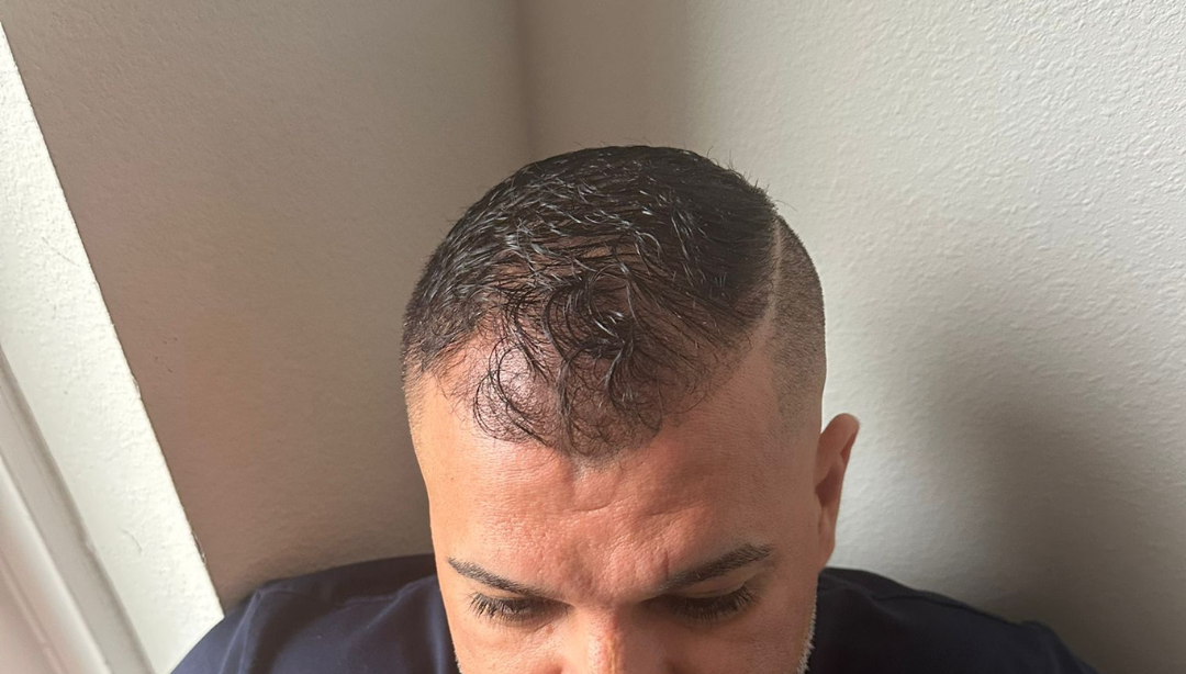 Man with a shaved head and a side part, showing a hair transplant with visible scabbing.