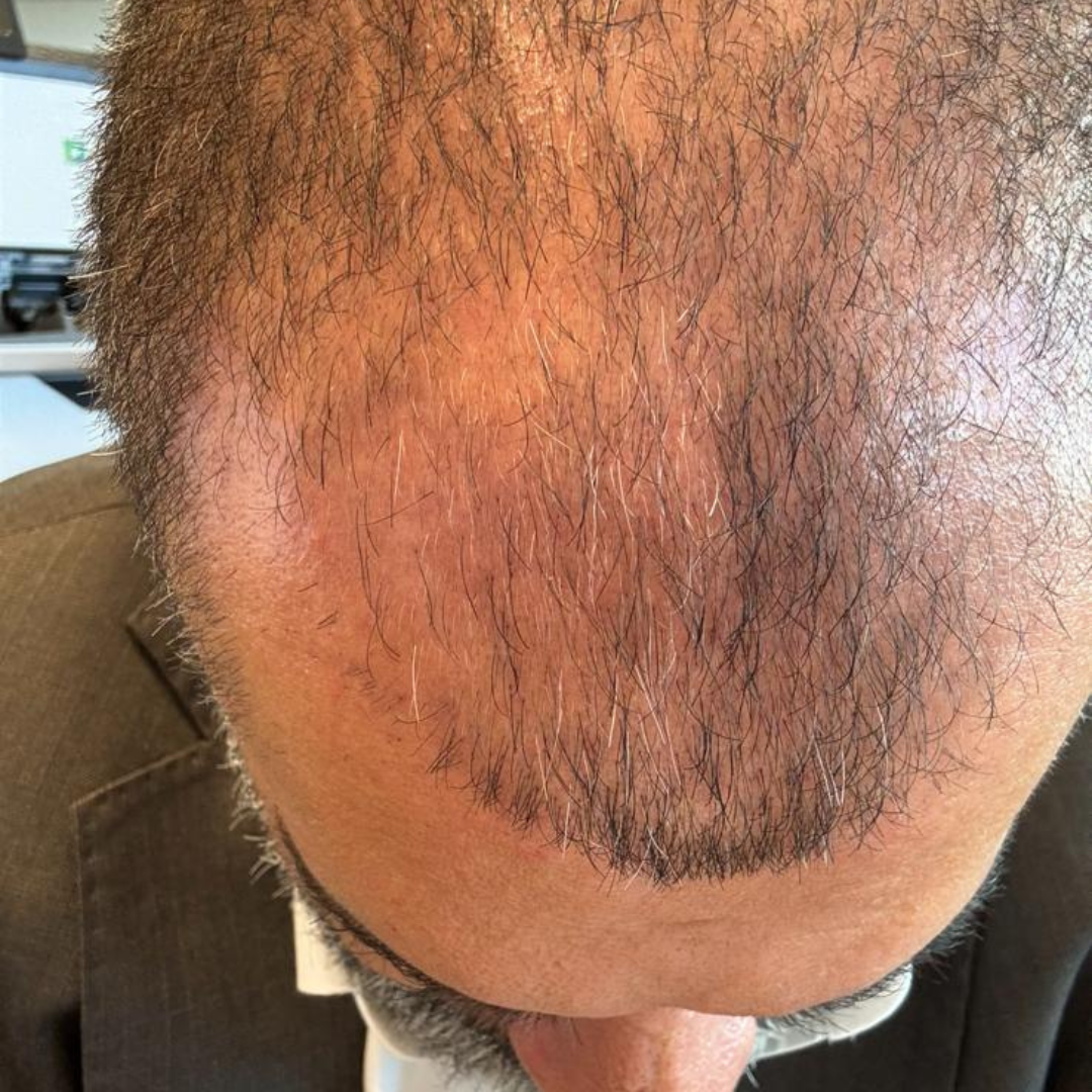 Man with thinning brown hair, receding hairline, and beard, wearing a blazer.