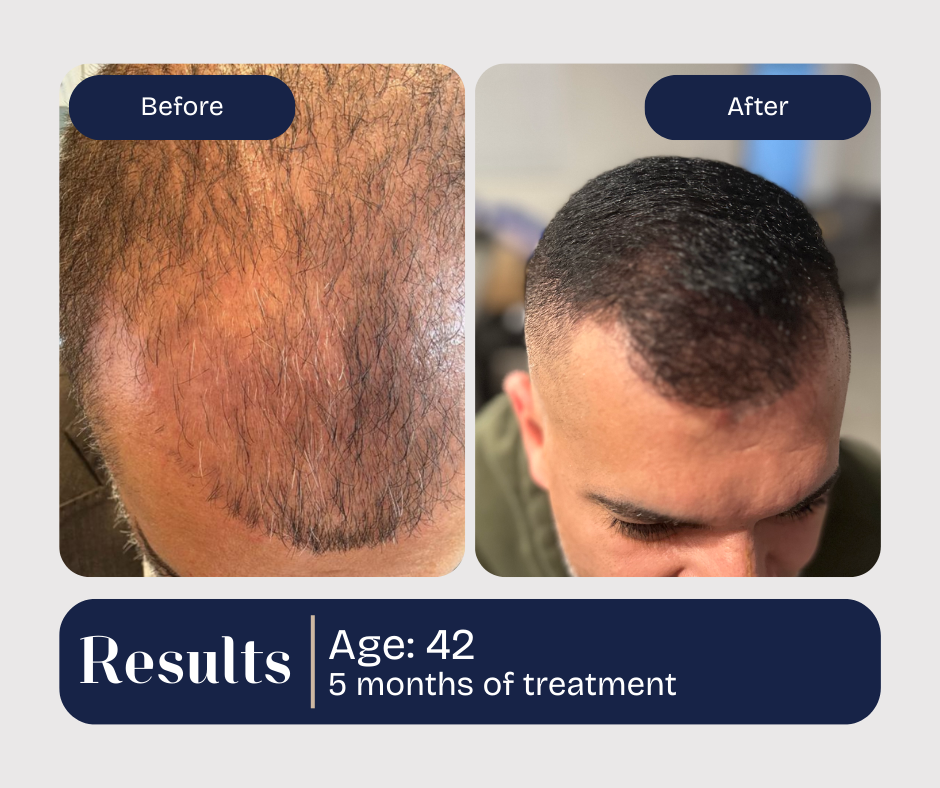 Before and after hair transplant results. A 42-year-old shows hair growth 5 months post-treatment.