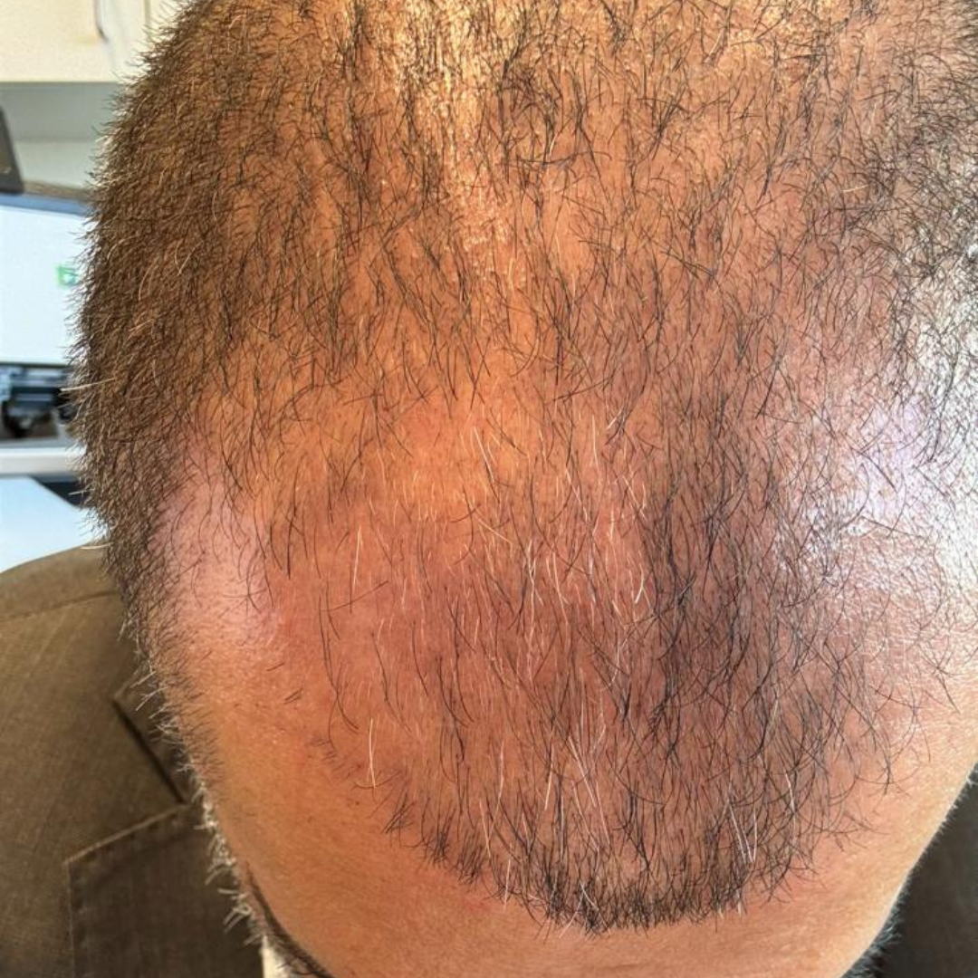 Man's head, balding on top, with dark brown hair and a trimmed hairline.