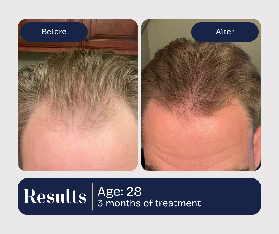 Before-and-after hair loss treatment comparison of a 28-year-old male. Hair density increased after 3 months of treatment.