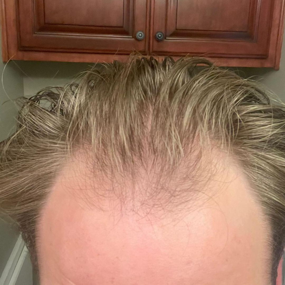 Close-up of a man's forehead showing receding hairline. Brown hair is lightened with highlights.