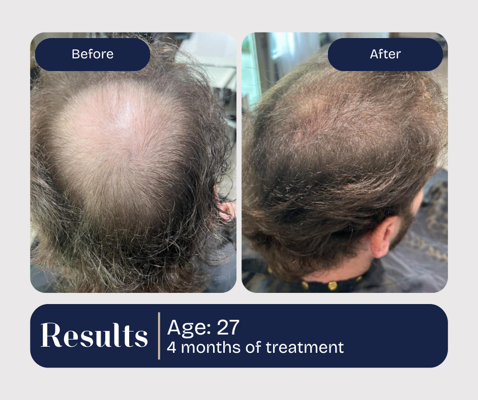 Hair loss treatment results: Before and after views, dark hair, 27-year-old, 4 months of treatment.