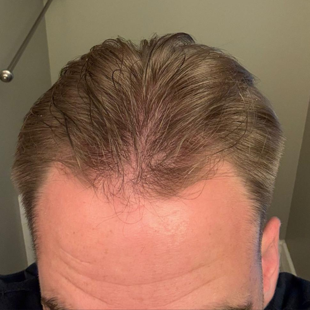 Man with thinning, light brown hair, receding hairline, in bathroom, looking at camera.
