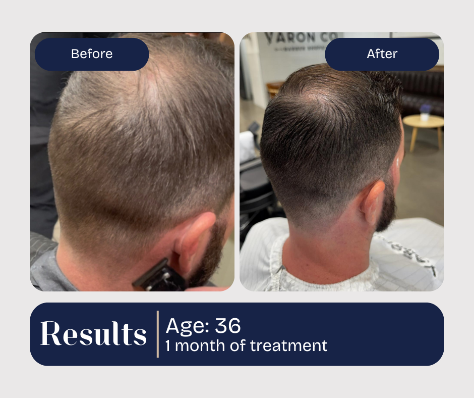 Before/after photos: 36-year-old man's scalp with hair loss, showing improved hair growth after one month of treatment.