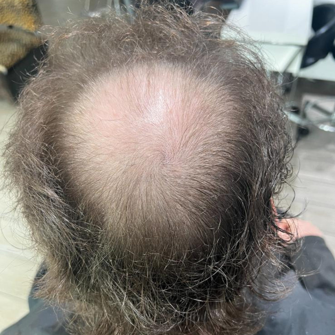 Bald crown of a person's head, surrounded by thinning, dark brown hair.