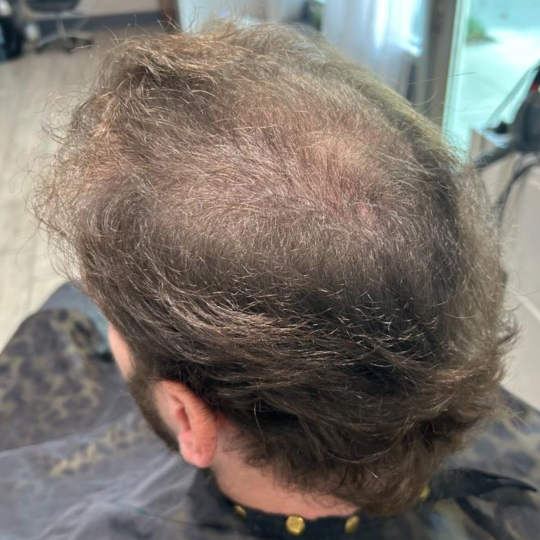 Man with thinning brown hair, seen from the back and above, at a salon, wearing a cape.