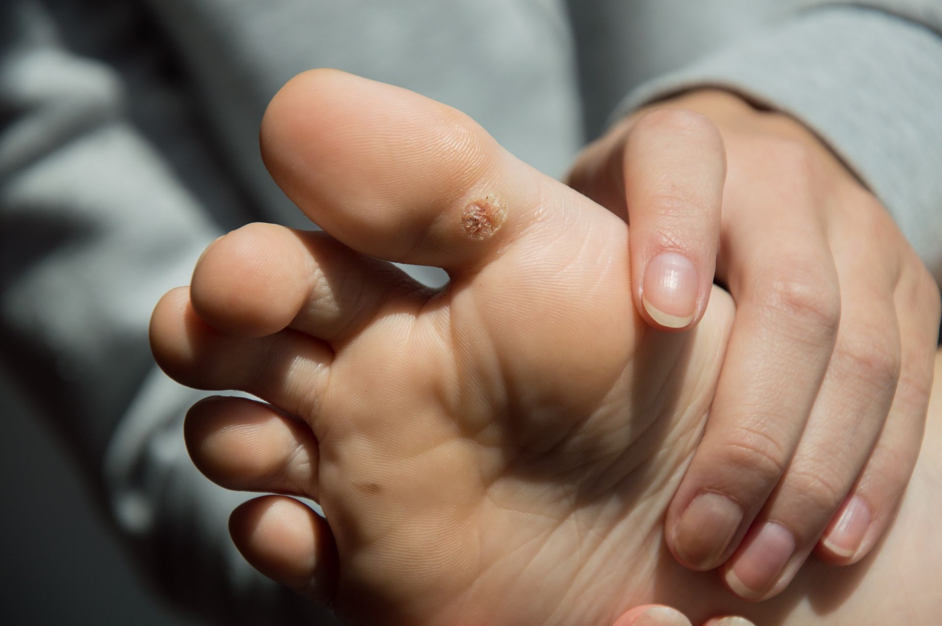 Foot with wart on the sole, being held by a hand, close-up.