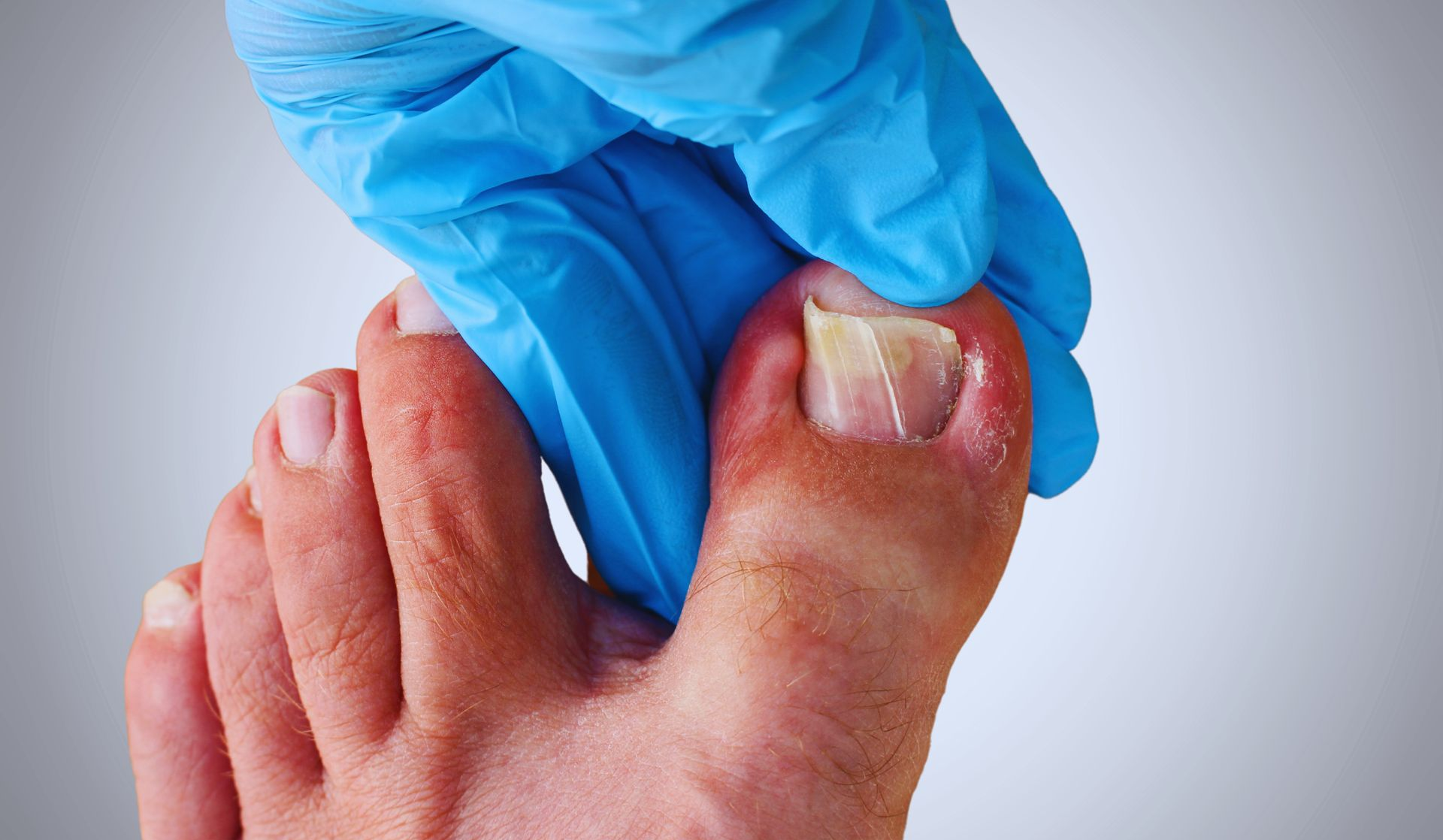 Foot with a toenail affected by a fungal infection, held by a gloved hand.