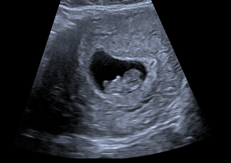 A black and white ultrasound of a baby in the womb.