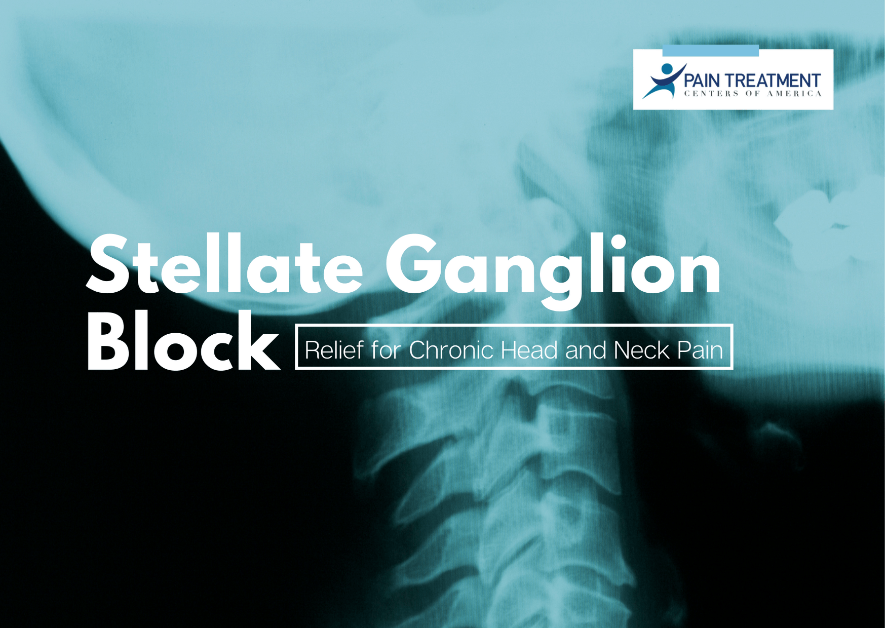 Stellate Ganglion Relief For Chronic Head And Neck Pain