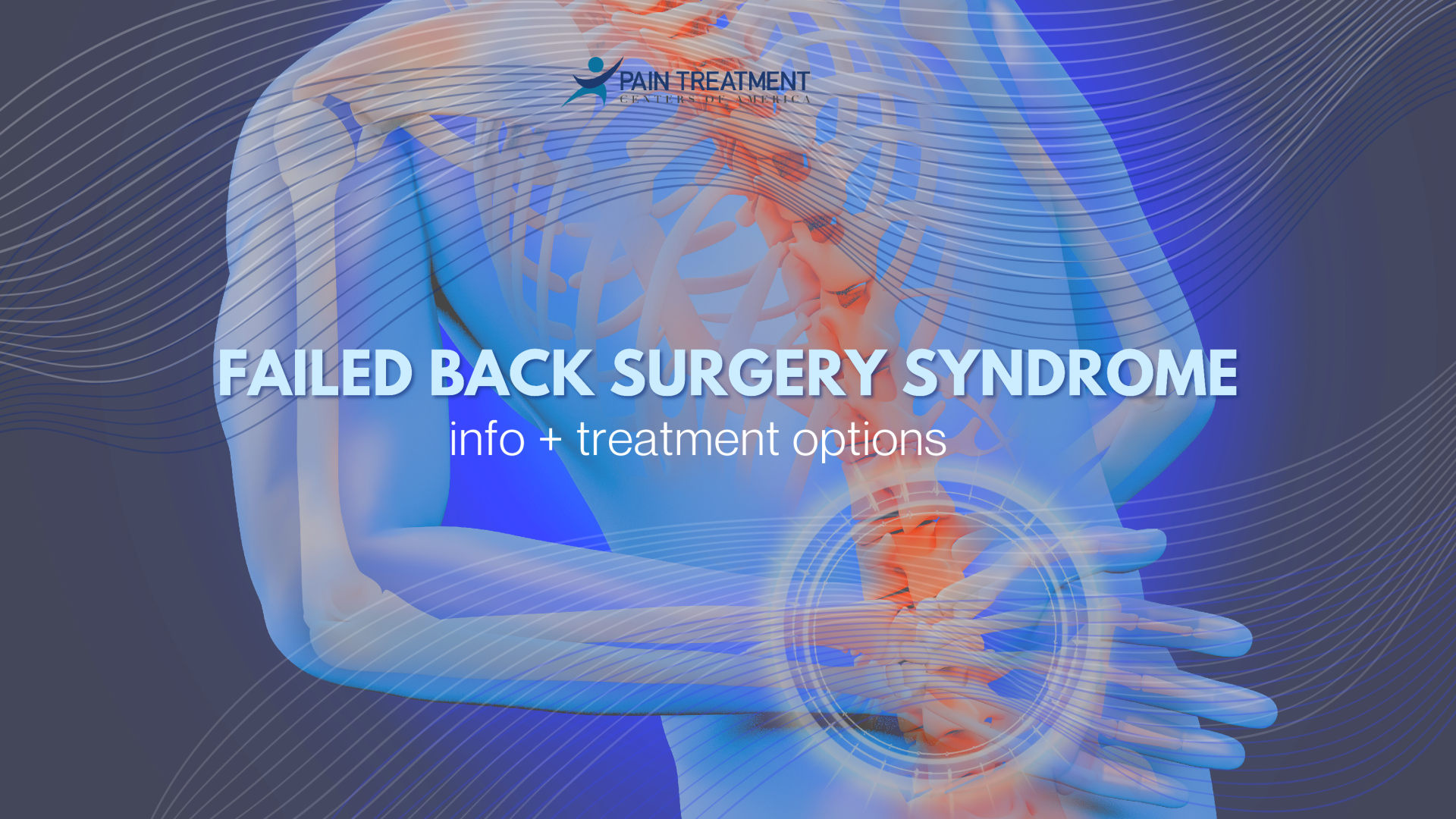 Failed Back Surgery Syndrome Graphic