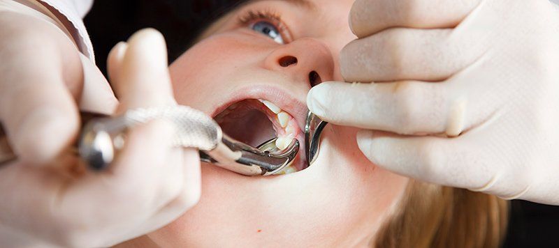 tooth being extracted from dental patient
