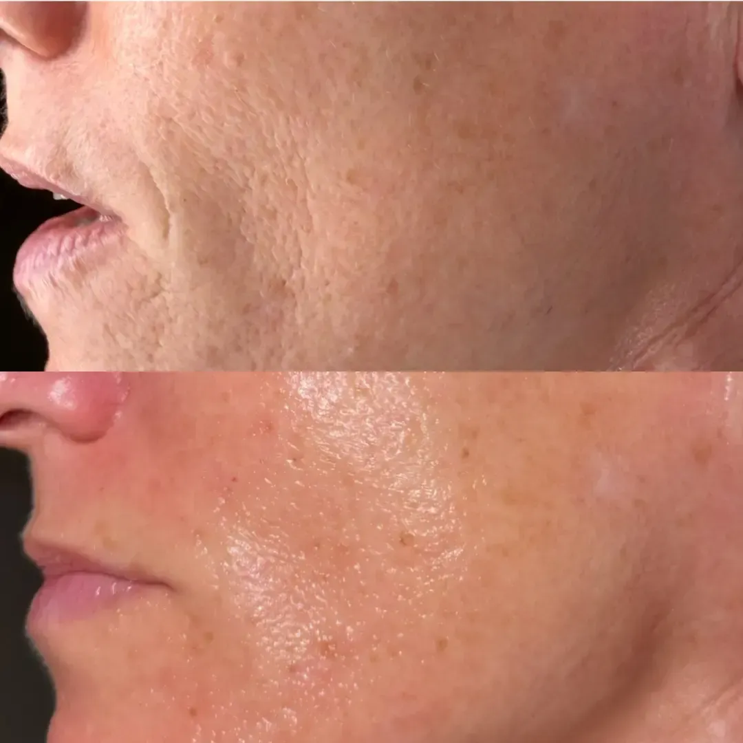 before and after image showing skin before using lumenvy skincare products