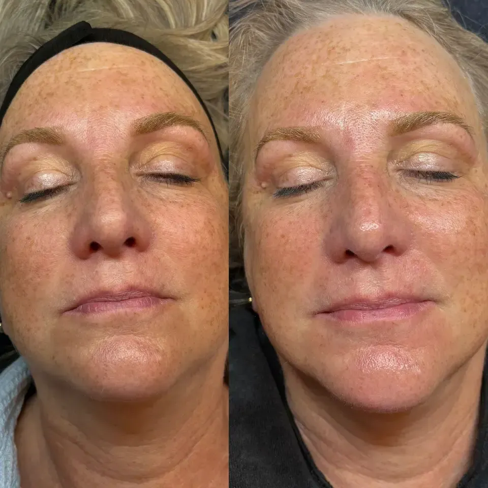 A split-screen comparison of a person's face before and after a cosmetic skin treatment, showing reduced hyperpigmentation.