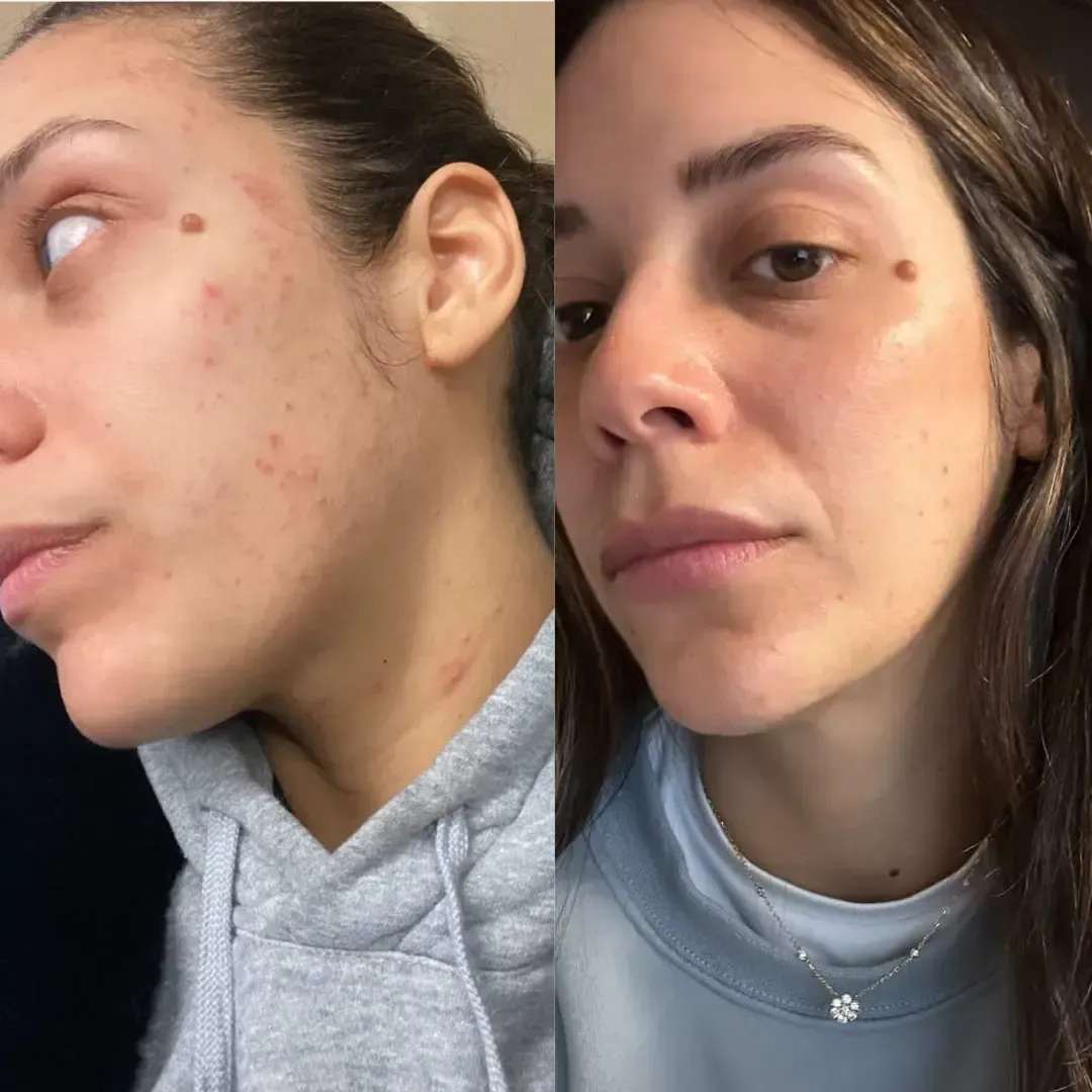 before and after image showing skin before using lumenvy skincare products